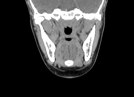 File:Chondroblastic osteosarcoma (Radiopaedia 67363-76741 D 57).jpg