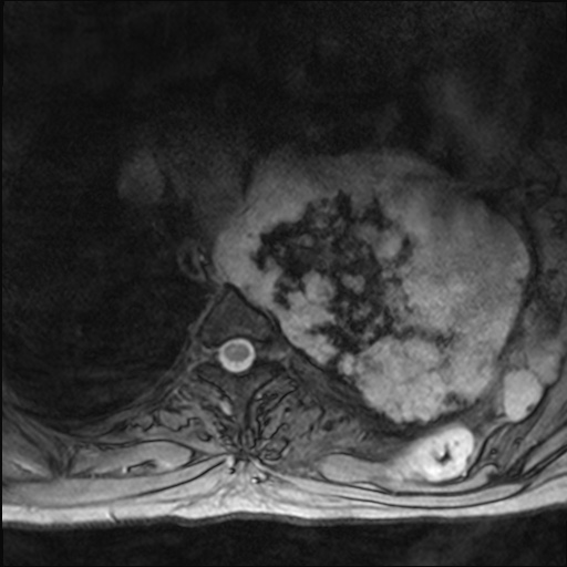 File:Chondrosarcoma - chest wall (Radiopaedia 65192-74200 Axial Gradient Echo 24).jpg