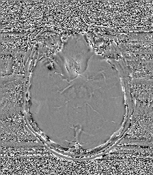 Chondrosarcoma - sphenoid wing (Radiopaedia 58259-67947 Axial SWI 31).jpg