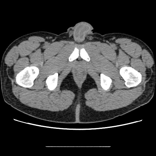 Chondrosarcoma of iliac wing (Radiopaedia 63861-72599 Axial non-contrast 121).jpg