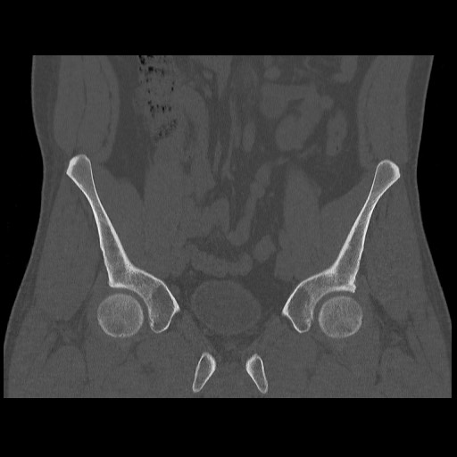 Chondrosarcoma of iliac wing (Radiopaedia 63861-72599 Coronal bone window 46).jpg