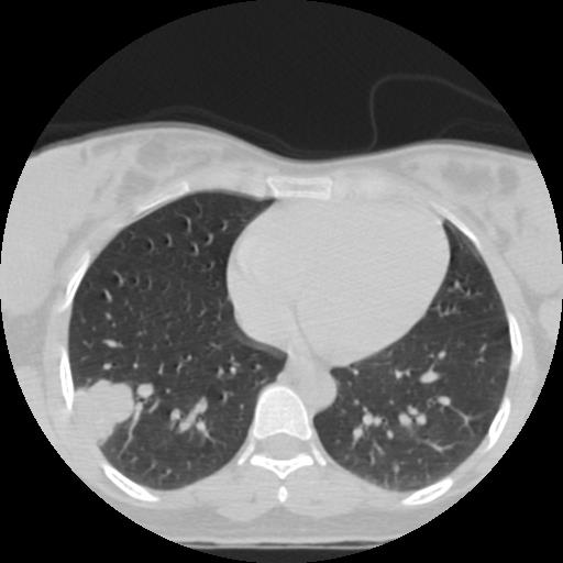 File:Choriocarcinoma of ovary with cerebral and pulmonary metastases (Radiopaedia 25983-26119 Axial lung window 9).jpg