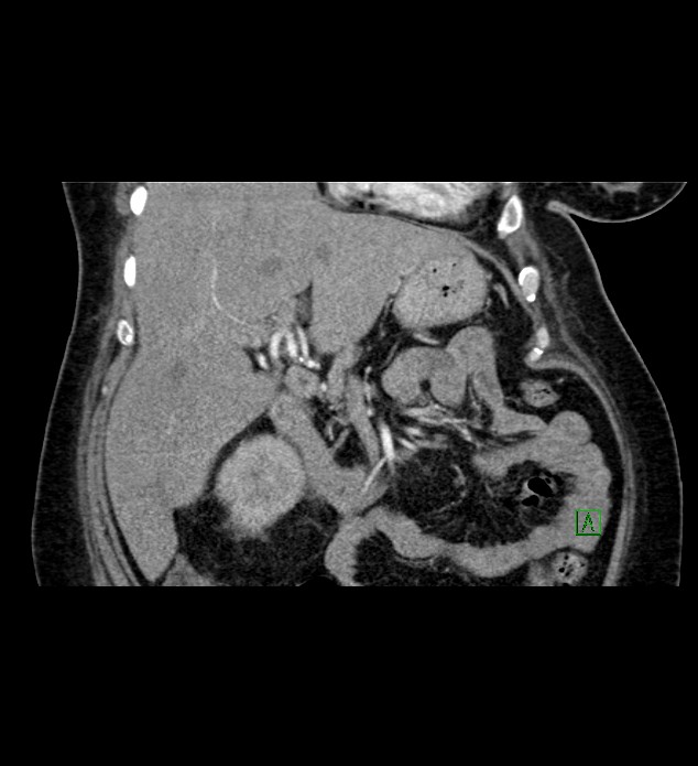 Chromophobe renal cell carcinoma (Radiopaedia 84239-99519 C 35).jpg
