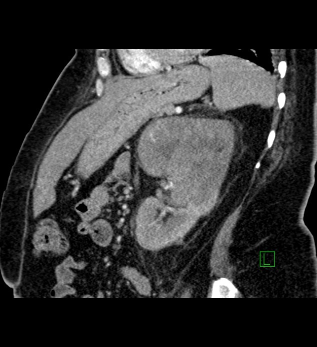 Chromophobe renal cell carcinoma (Radiopaedia 84239-99519 D 41).jpg