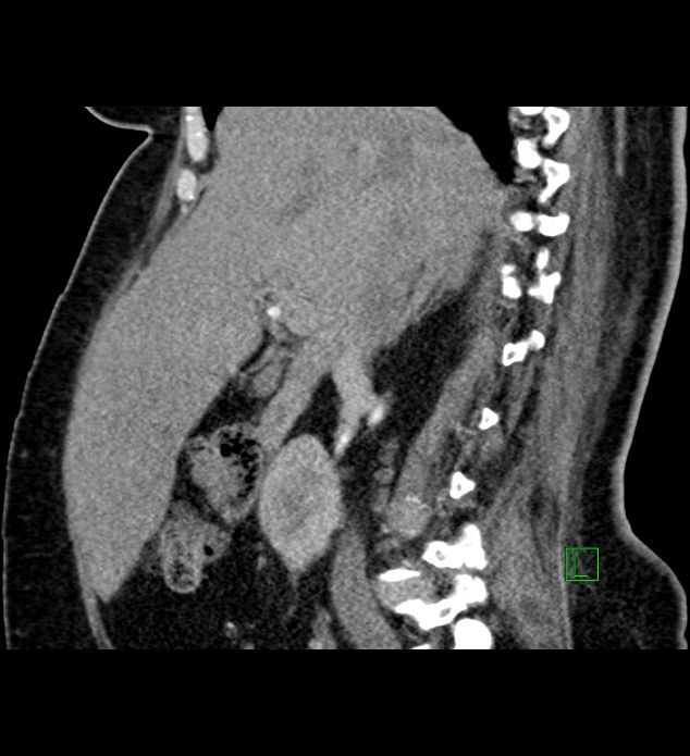 Chromophobe renal cell carcinoma (Radiopaedia 84239-99519 D 72).jpg