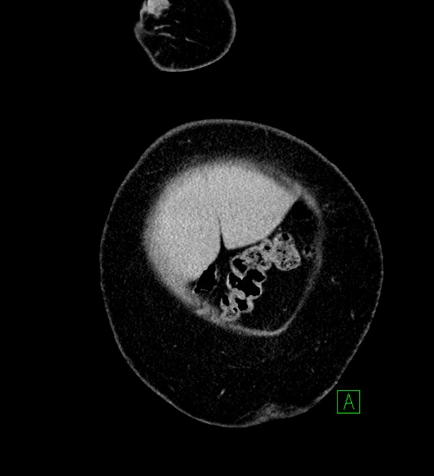 Chromophobe renal cell carcinoma (Radiopaedia 84239-99519 F 6).jpg