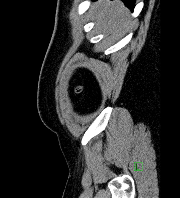 Chromophobe renal cell carcinoma (Radiopaedia 84286-99573 C 178).jpg