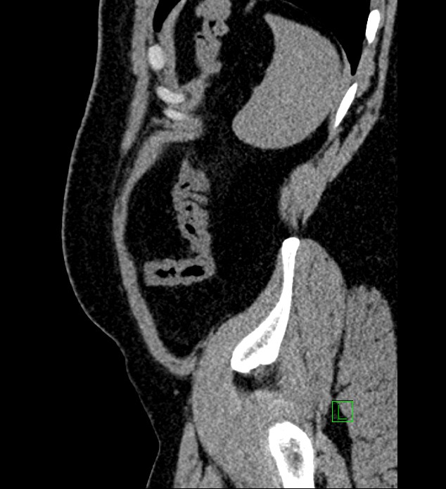 Chromophobe renal cell carcinoma (Radiopaedia 84286-99573 C 18).jpg
