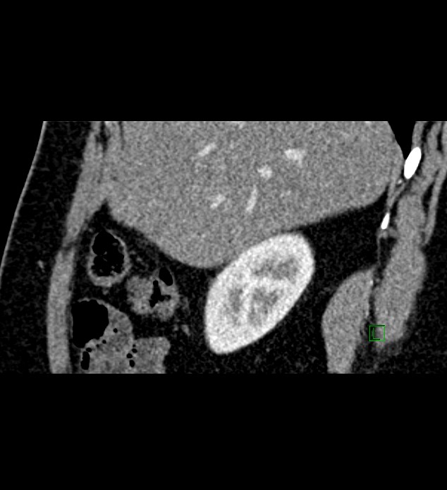 Chromophobe renal cell carcinoma (Radiopaedia 84286-99573 F 133).jpg