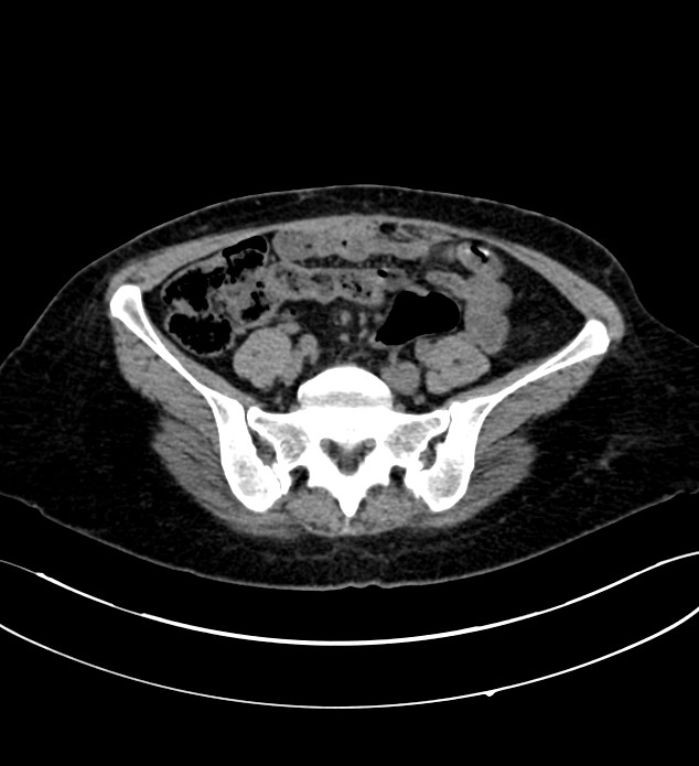 Chromophobe renal cell carcinoma (Radiopaedia 84290-99582 Axial non-contrast 106).jpg