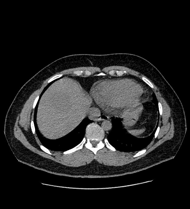 Chromophobe renal cell carcinoma (Radiopaedia 84337-99693 Axial non-contrast 3).jpg