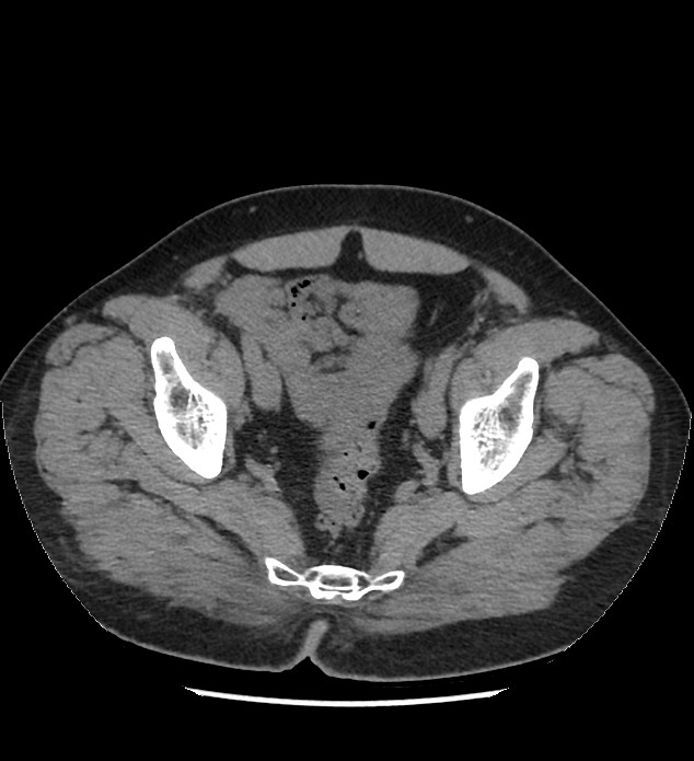 Chromophobe renal cell carcinoma (Radiopaedia 86879-103083 Axial non-contrast 112).jpg