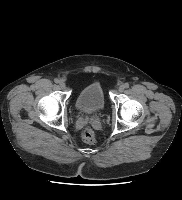 Chromophobe renal cell carcinoma (Radiopaedia 86879-103083 Axial non-contrast 123).jpg