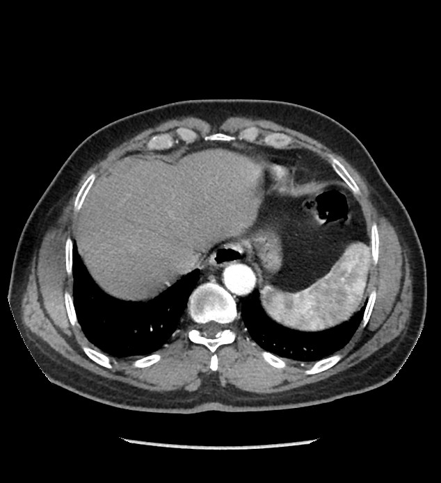 Chromophobe renal cell carcinoma (Radiopaedia 86879-103083 B 21).jpg