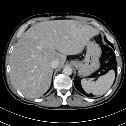 Chronic appendicitis complicated by appendicular abscess, pylephlebitis and liver abscess (Radiopaedia 54483-60700 B 38).jpg