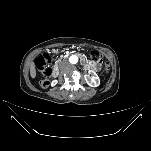 Chronic contained rupture of abdominal aortic aneurysm with extensive erosion of the vertebral bodies (Radiopaedia 55450-61901 A 24).jpg