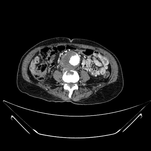 File:Chronic contained rupture of abdominal aortic aneurysm with extensive erosion of the vertebral bodies (Radiopaedia 55450-61901 A 38).jpg