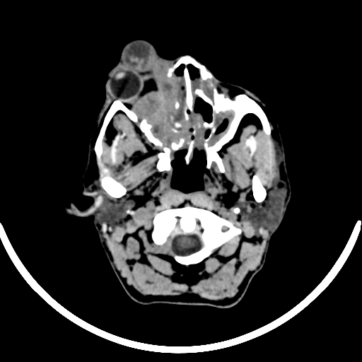 File:Chronic invasive fungal sinusitis with intraorbital and intracranial extension (Radiopaedia 56387-63046 Axial non-contrast 79).jpg