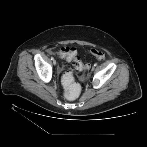 Chronic mesenteric ischemia - arterial (Radiopaedia 88205-104810 A 72).jpg
