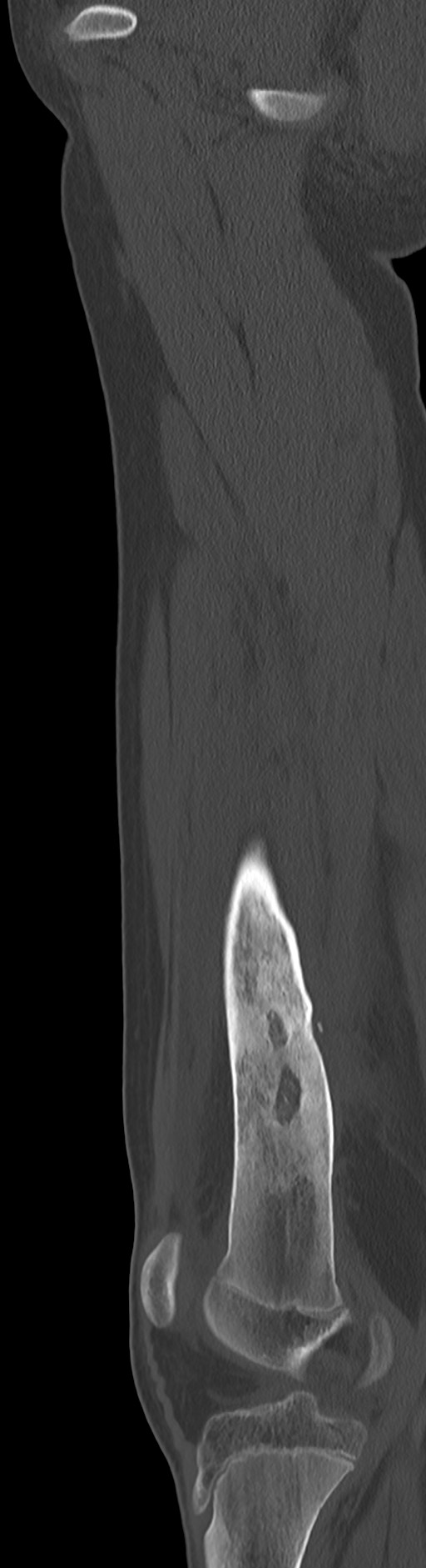 Chronic ostemyelitis of the femur with long sinus tract (Radiopaedia 74947-85982 Sagittal bone window 57).jpg