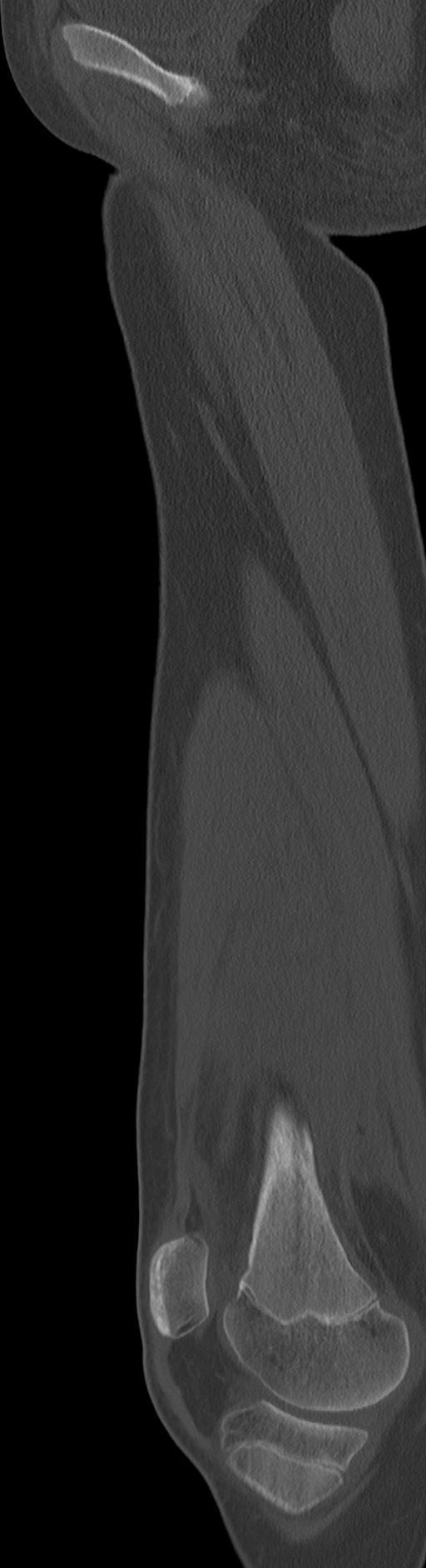 Chronic ostemyelitis of the femur with long sinus tract (Radiopaedia 74947-85982 Sagittal bone window 64).jpg