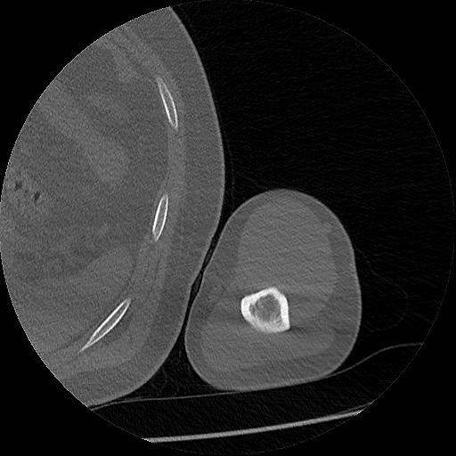 Chronic osteomyelitis (Radiopaedia 67597-76998 Axial bone window 48).jpg