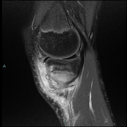 File:Chronic osteomyelitis (with Brodie abscess) (Radiopaedia 76405-88112 Sagittal PD fat sat 6).jpg