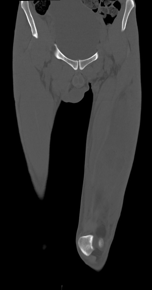 Chronic osteomyelitis (with sequestrum) (Radiopaedia 74813-85822 Coronal non-contrast 13).jpg