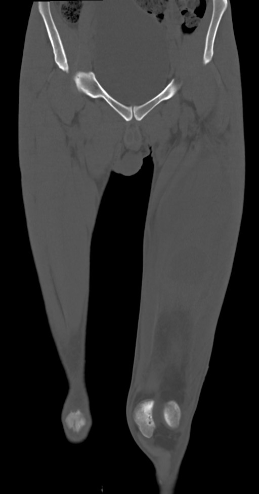 Chronic osteomyelitis (with sequestrum) (Radiopaedia 74813-85822 Coronal non-contrast 15).jpg