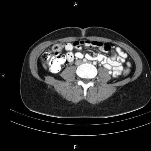 Chronic pancreatitis (Radiopaedia 64576-73450 B 101).jpg