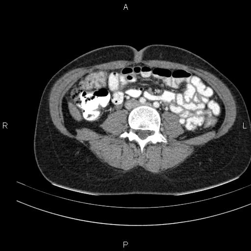 File:Chronic pancreatitis (Radiopaedia 64576-73450 B 99).jpg