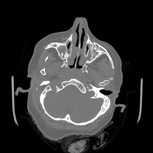 Chronic sinusitis with intra-sinus calcification (Radiopaedia 63919-72668 Axial bone window 54).jpg
