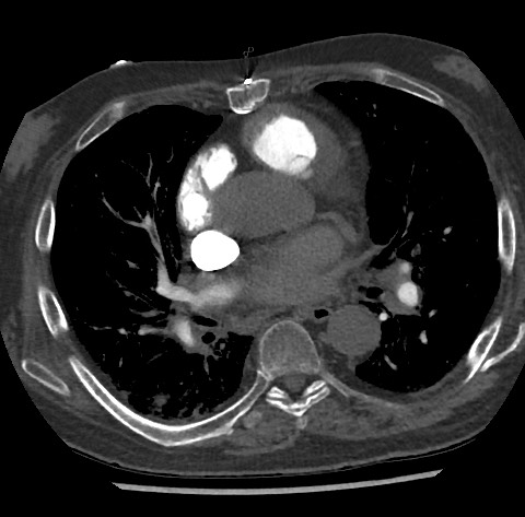 File:Chronic thromboembolic pulmonary disease (Radiopaedia 90694-108119 Axial C+ CTPA 53).jpg