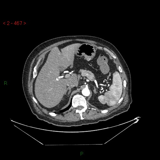 Circumaortic left renal vein and doubled left renal arteries (Radiopaedia 52268-58158 A 3).jpg