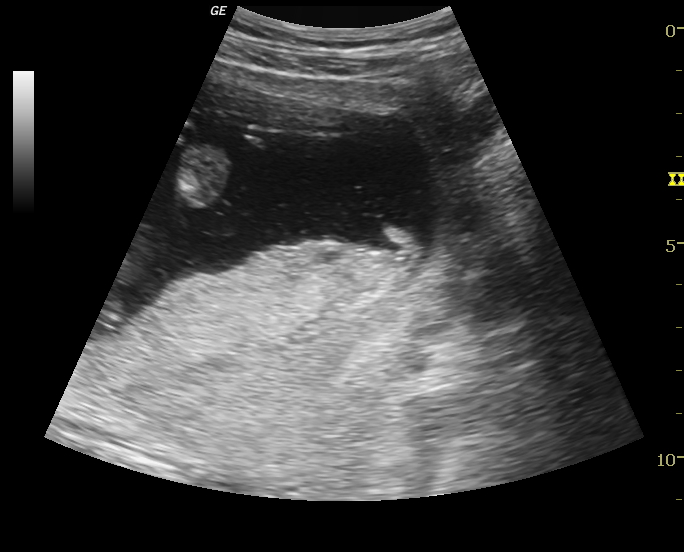 File:Circumvallate placenta (Radiopaedia 21748-21727 A 1).jpg