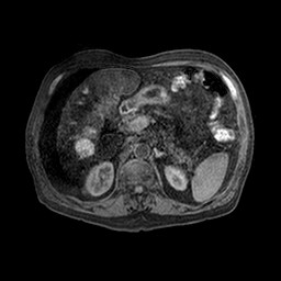 Cirrhosis and hepatocellular carcinoma in the setting of hemochromatosis (Radiopaedia 75394-86594 Axial T1 C+ fat sat 36).jpg