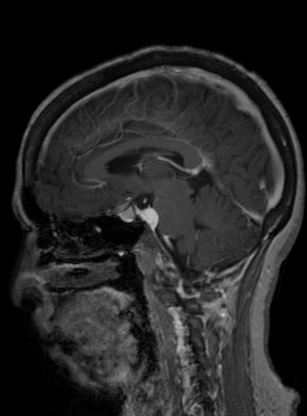 Clival meningioma (Radiopaedia 53278-59248 Sagittal T1 C+ 266).jpg