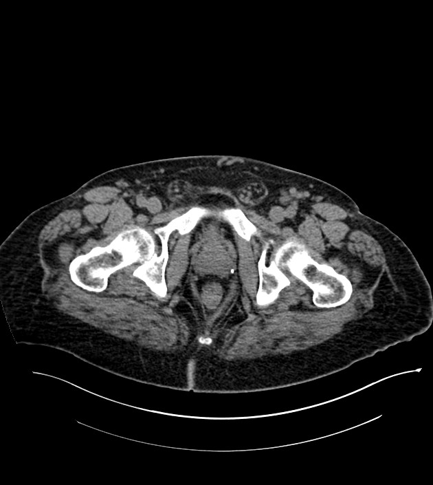 Closed-loop small bowel obstruction-internal hernia (Radiopaedia 78439-91096 Axial non-contrast 153).jpg