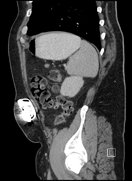 Closed loop obstruction - internal hernia into nephrectomy bed (Radiopaedia 59867-67320 C 12).jpg