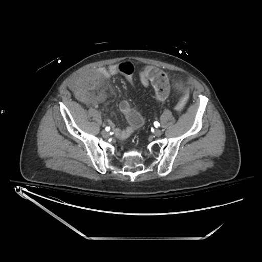 Closed loop obstruction due to adhesive band, resulting in small bowel ischemia and resection (Radiopaedia 83835-99023 B 118).jpg