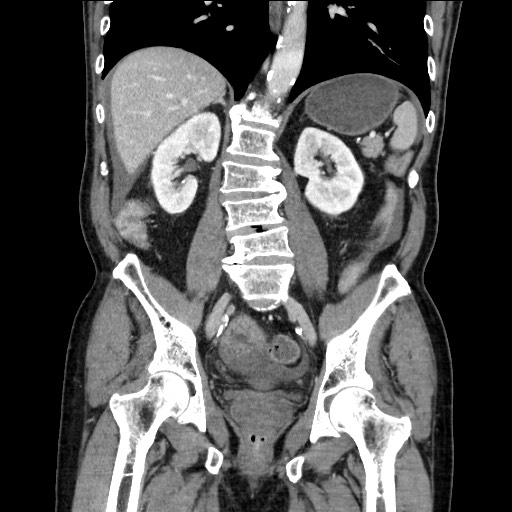 Closed loop obstruction due to adhesive band, resulting in small bowel ischemia and resection (Radiopaedia 83835-99023 E 82).jpg