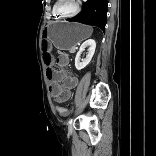 File:Closed loop obstruction due to adhesive band, resulting in small bowel ischemia and resection (Radiopaedia 83835-99023 F 125).jpg