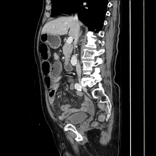 File:Closed loop obstruction due to adhesive band, resulting in small bowel ischemia and resection (Radiopaedia 83835-99023 F 85).jpg