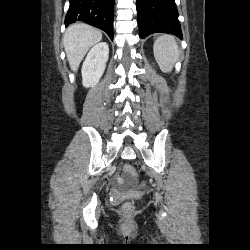 Closed loop small bowel obstruction (Radiopaedia 65403-74451 B 81).jpg