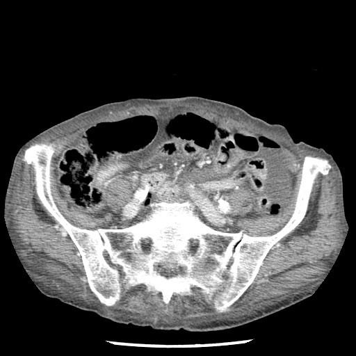 File:Closed loop small bowel obstruction - adhesions and infarct (Radiopaedia 85125-100678 B 69).jpg