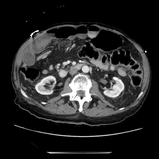 File:Closed loop small bowel obstruction - adhesive disease and hemorrhagic ischemia (Radiopaedia 86831-102990 A 89).jpg
