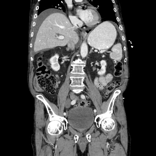 Closed loop small bowel obstruction - adhesive disease and hemorrhagic ischemia (Radiopaedia 86831-102990 B 69).jpg