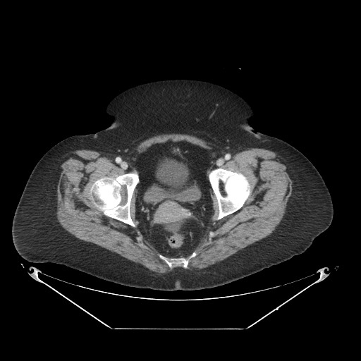 Closed loop small bowel obstruction - internal hernia (Radiopaedia 65402-74450 A 124).jpg