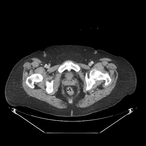 Closed loop small bowel obstruction - internal hernia (Radiopaedia 65402-74450 A 133).jpg