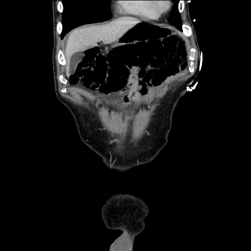 Closed loop small bowel obstruction - omental adhesion causing "internal hernia" (Radiopaedia 85129-100682 B 31).jpg
